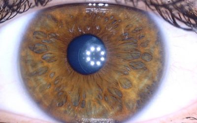 What is Iridology?